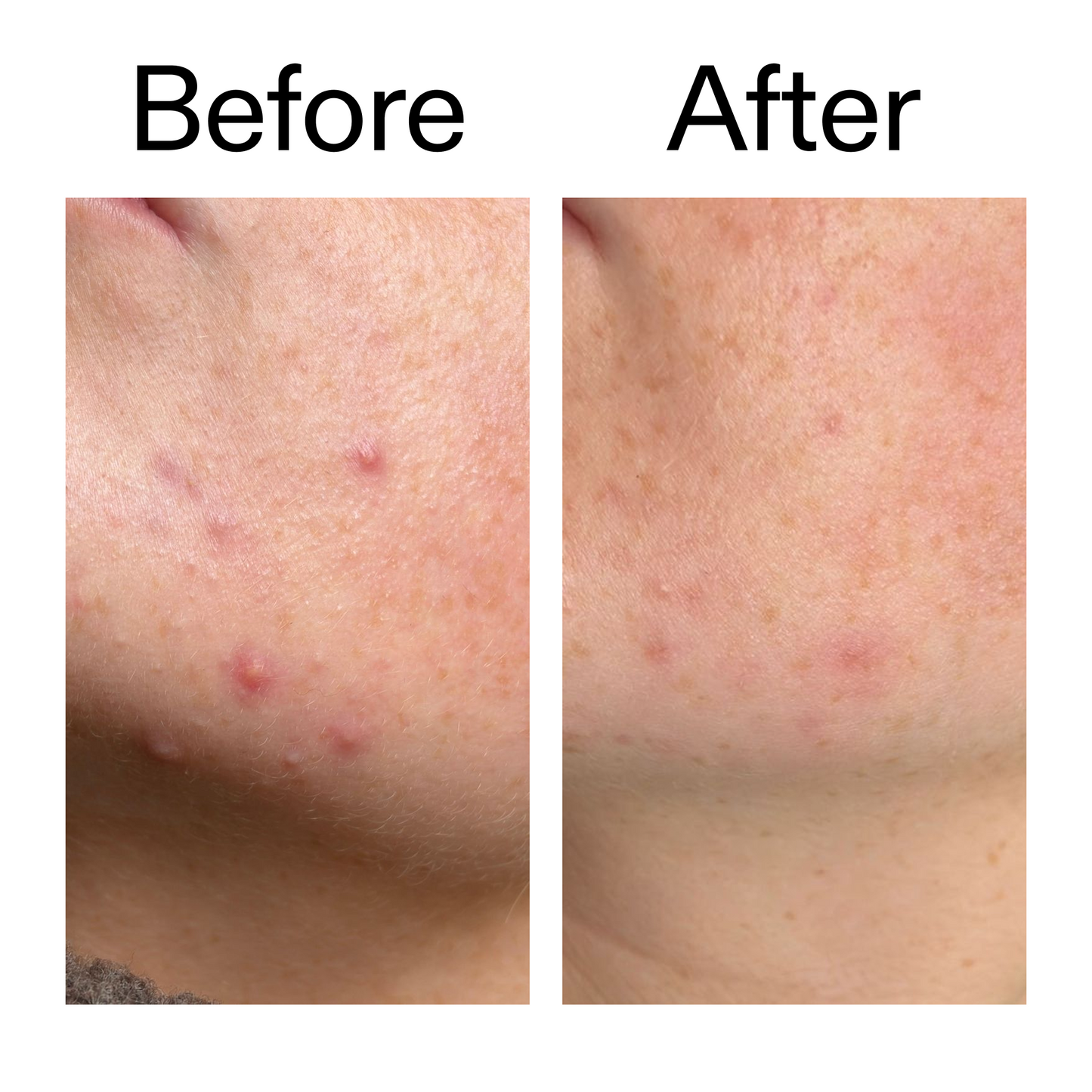 10-azelaic-acid-serum-for-redness-relief-f0 B_A_1_PPAGE.png