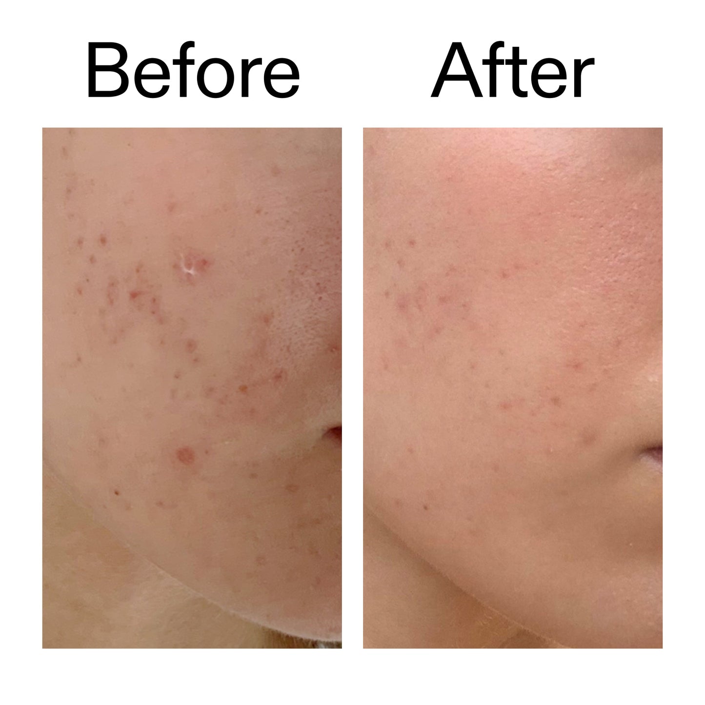 mandelic-acid-treatment-z2 Mandelic_Acid_Treatment_Before_After_2000x2000_4885ac6e-c5d7-4279-a72a-1417af7dce35.jpg