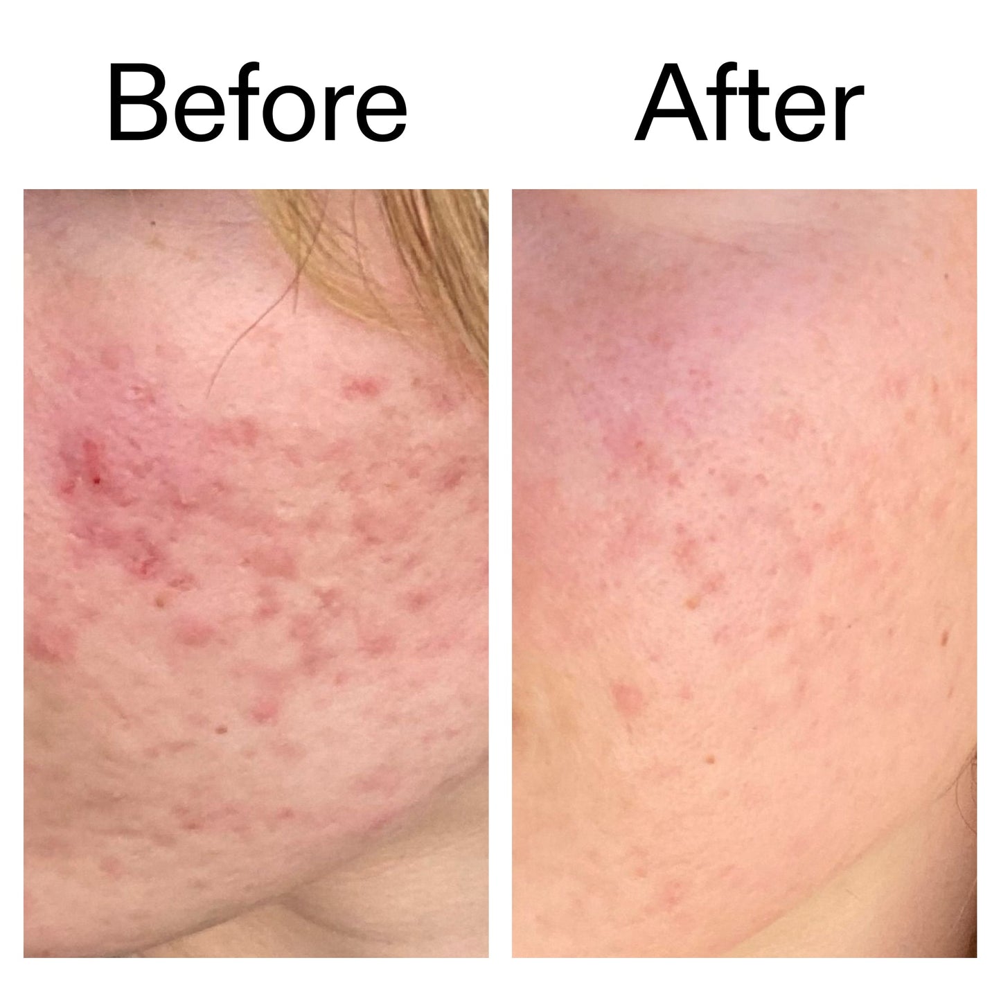 10-azelaic-acid-serum-for-redness-relief-f0 Azealic_Acid_Serum_B_A_Ppage_2000_x_2000.jpg
