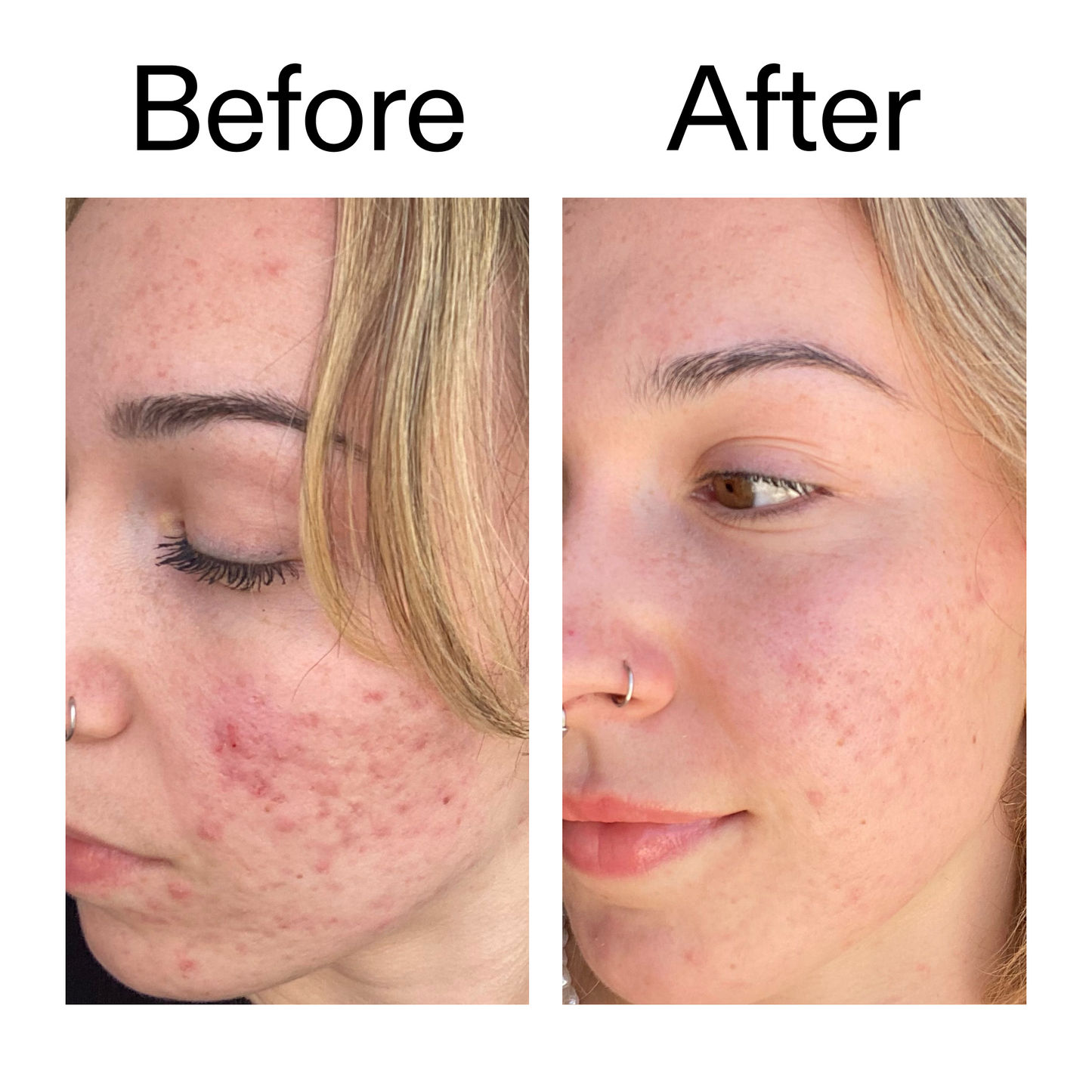 10-azelaic-acid-serum-for-redness-relief-f0 B_A_2_PPAGE.png