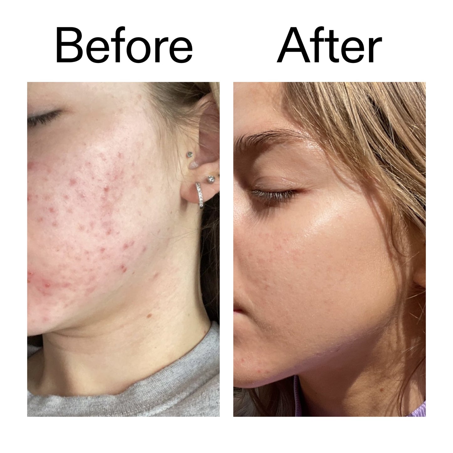 beta-hydroxy-acid-bha-serum-w9 Beta_Hydroxy_Acid_Serum_Before_After_2000x2000_96fda3e5-938d-49ef-bcf2-a0fa6ece4e2c.jpg