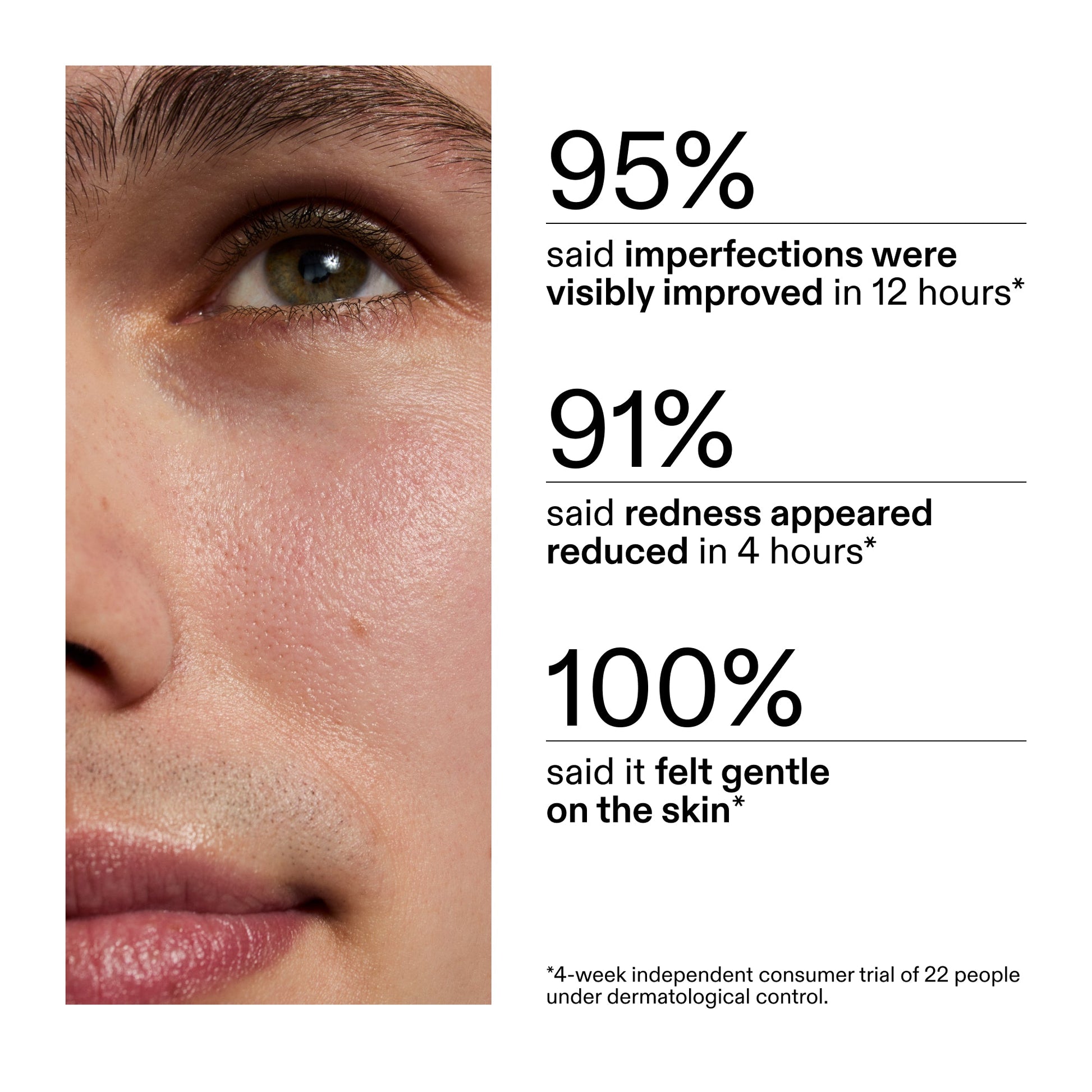 succinic-acid-acne-treatment-t8 CA_Succinic_Acid_Treatment_key_Claims_2000x2000_db91b0f1-7f29-4bfe-bb16-63a47f500960.jpg
