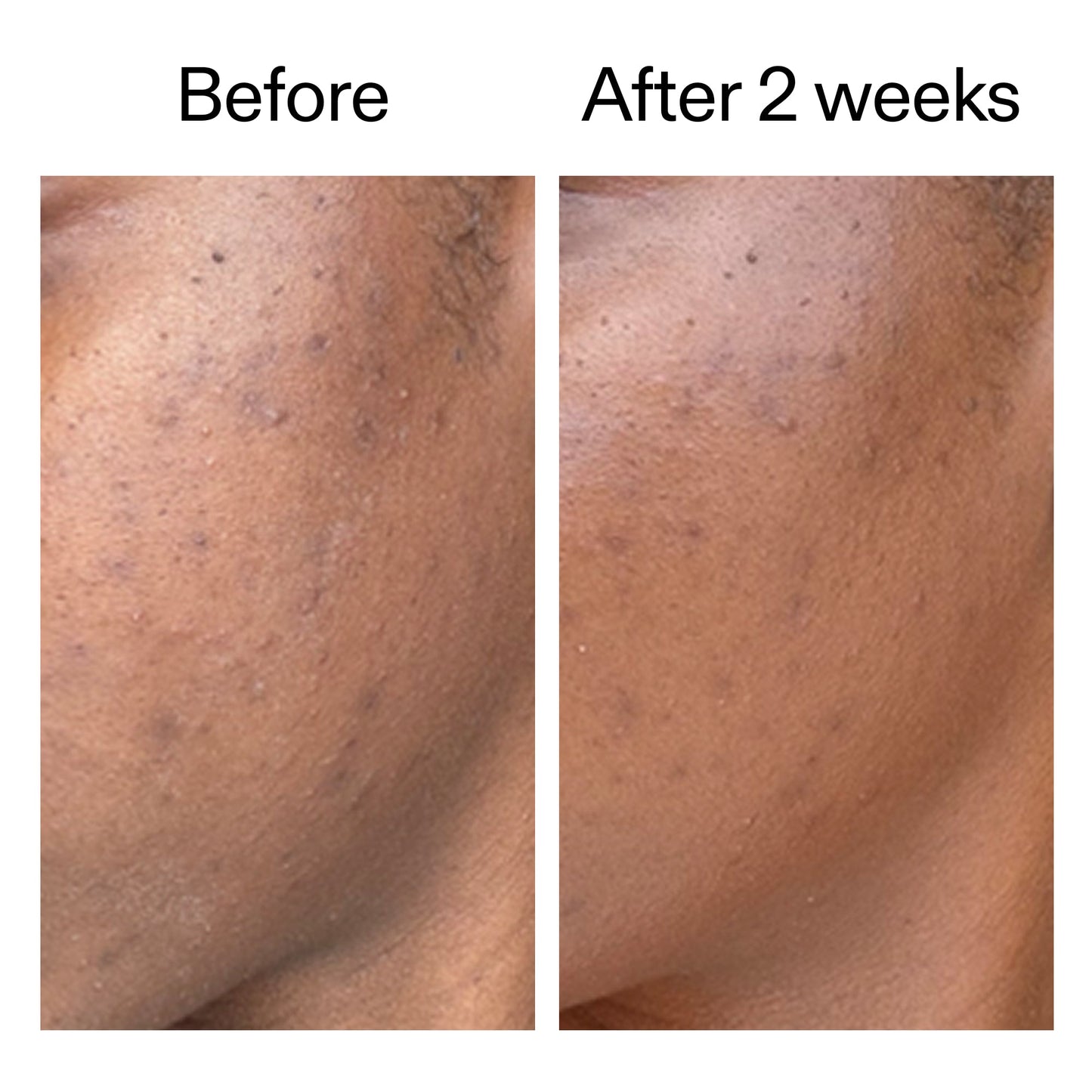 360-acne-clearing-duo-p8 DIOICB_A2000x2000.jpg