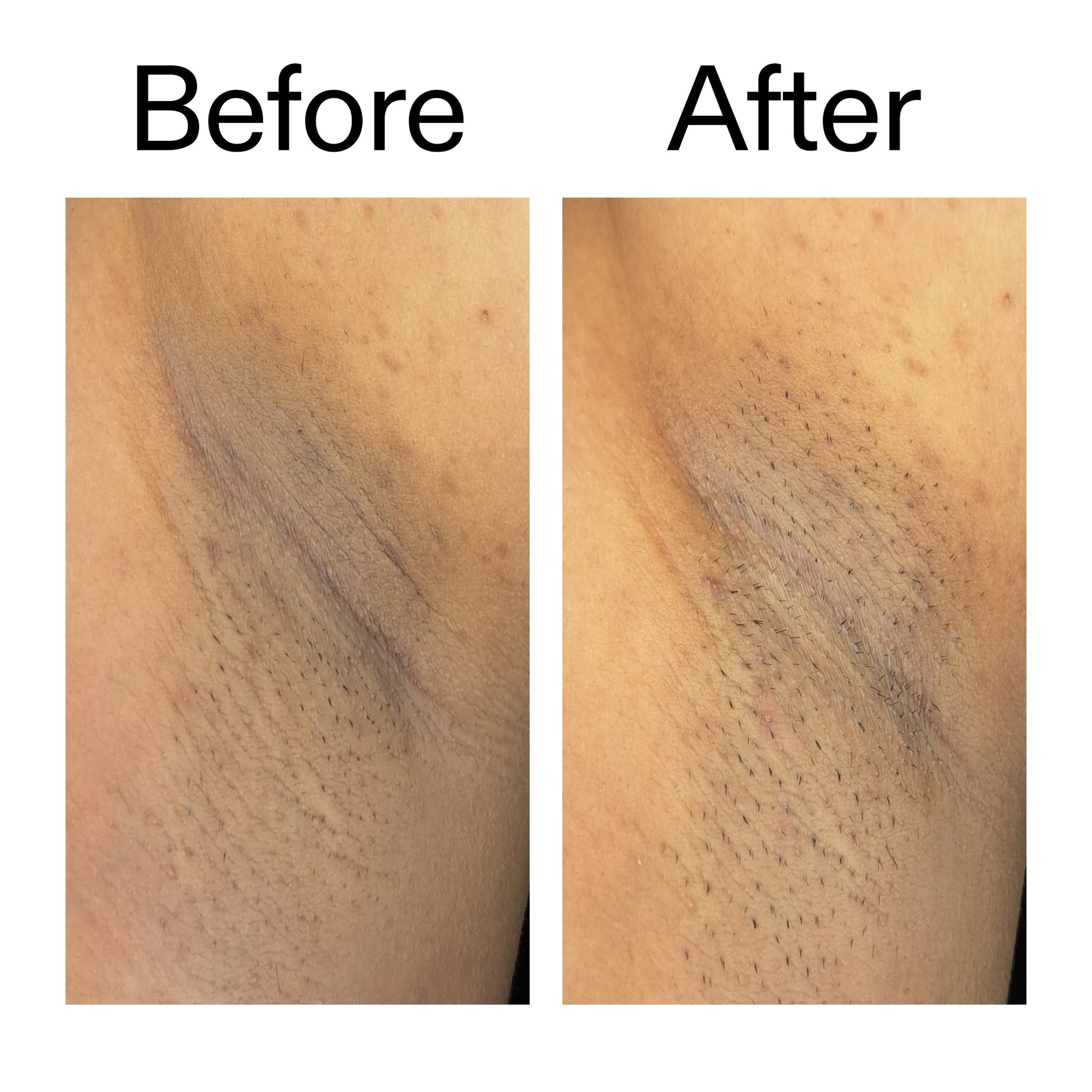 glycolic-acid-exfoliating-body-stick-h1 Glycolic_Acid_Exfoliating_Body_Stick_Before_After_V3_2000x2000_ea919cd9-1439-4a46-82a0-76200eb5bb42.jpg