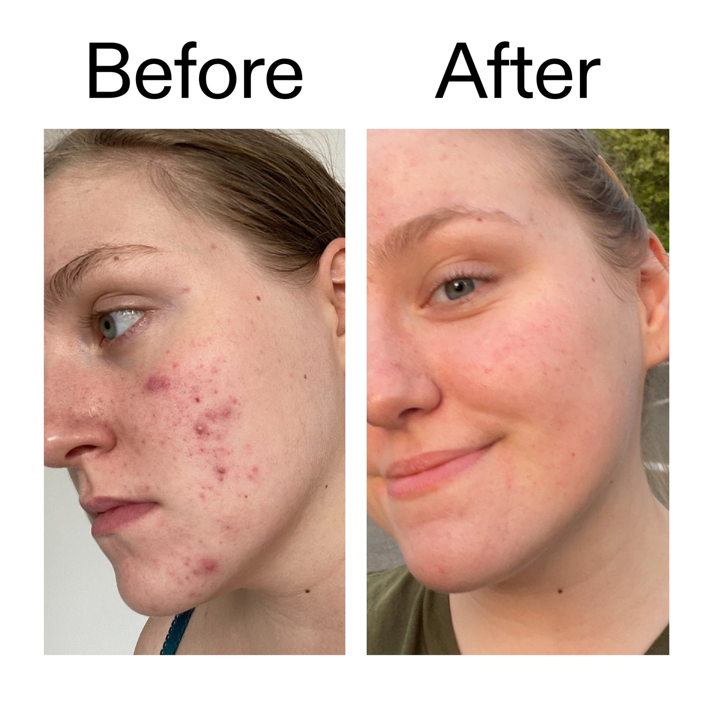 glycolic-acid-toner-z0 Glycolic_Acid_Toner_Before_After_2000x2000_49f0b9f7-e71b-4b2e-a8f8-2ea4b73247bb.jpg