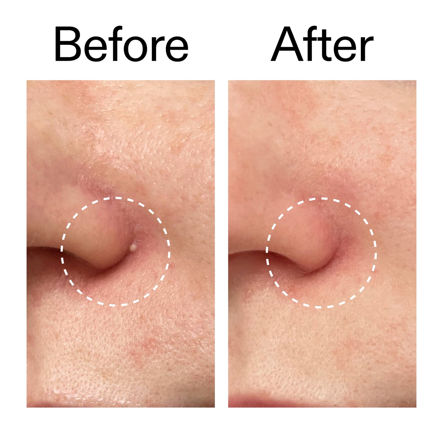 hydrocolloid-invisible-pimple-patches-pack-of-22-h0 Hydrocolloid_Invisible_Pimple_Patches_Before_After_2000x2000_b02aa37b-c78a-4682-91de-9135af5bb7df.jpg