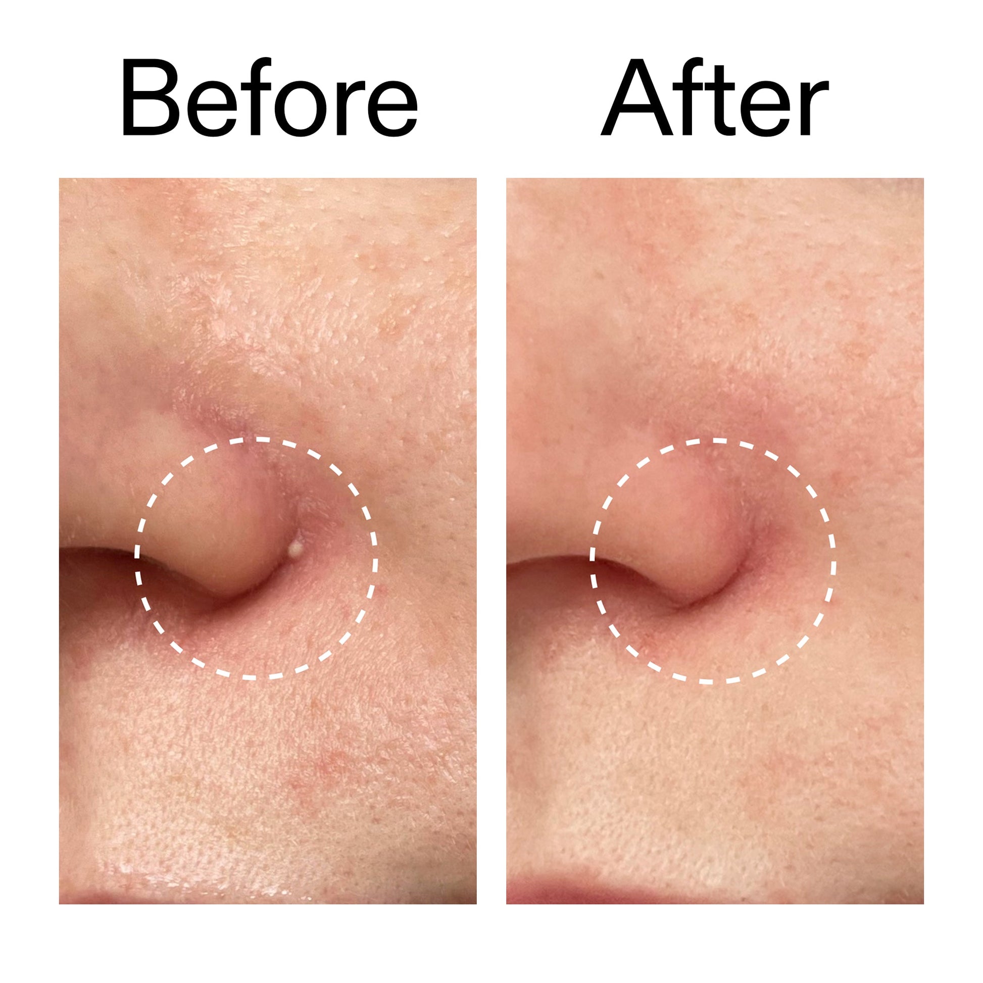 hydrocolloid-invisible-pimple-patches-pack-of-22-h0 Hydrocolloid_Invisible_Pimple_Patches_Before_After_2000x2000_b02aa37b-c78a-4682-91de-9135af5bb7df.jpg