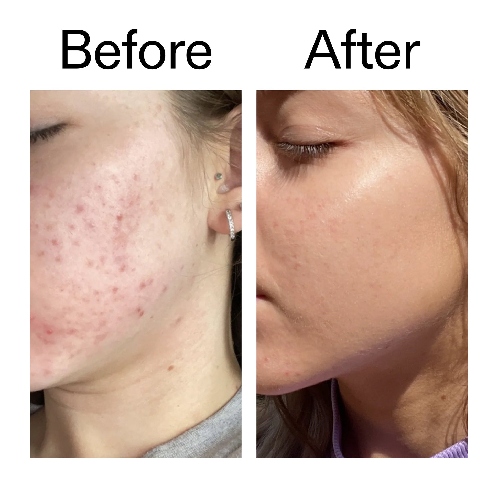 10-niacinamide-serum-l2 Niacinamide_Serum_Before_After_2000x2000_bde32455-9e7d-448e-b053-bef41504f0a9.jpg