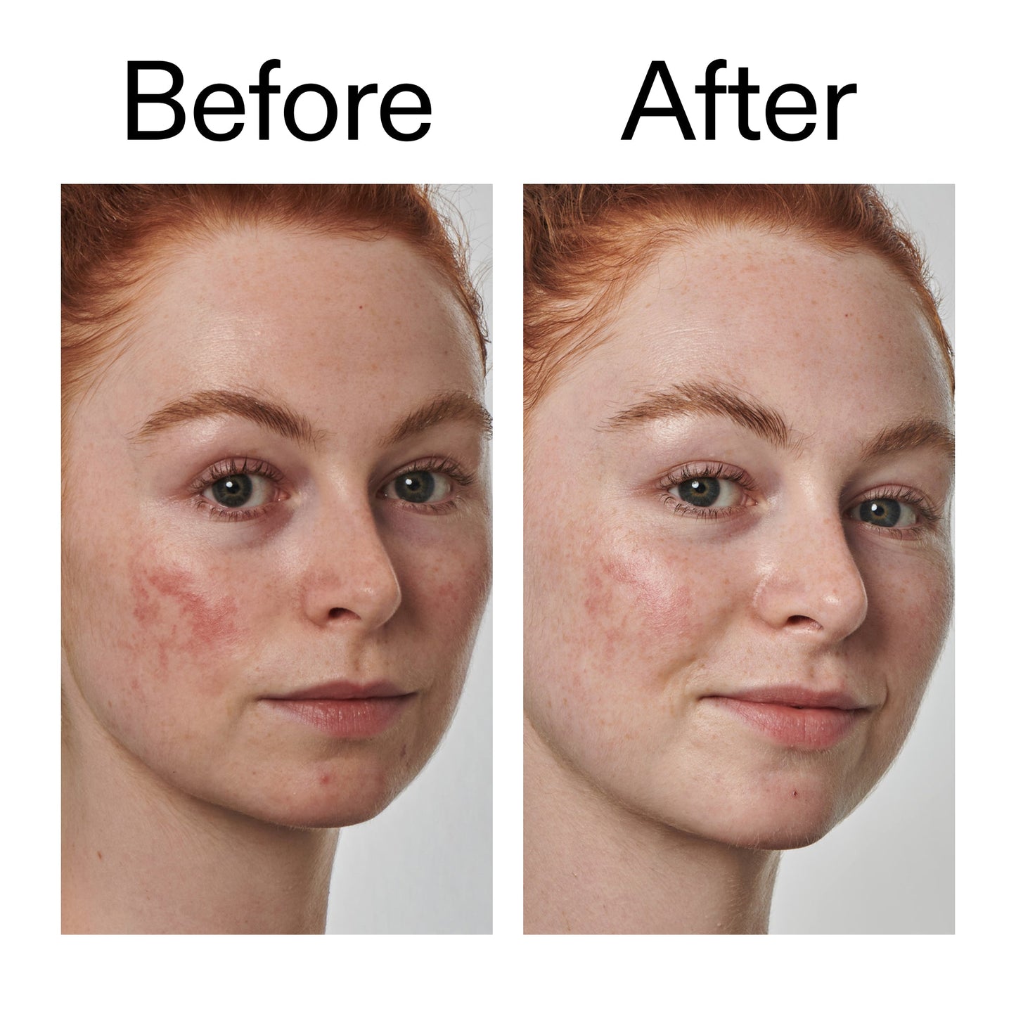 10-azelaic-acid-serum-for-redness-relief-f0 Redness_Relief_Serum_Before_After_2000x2000_3334dc9a-cce9-4e00-8aec-7ad89ca051f2.jpg