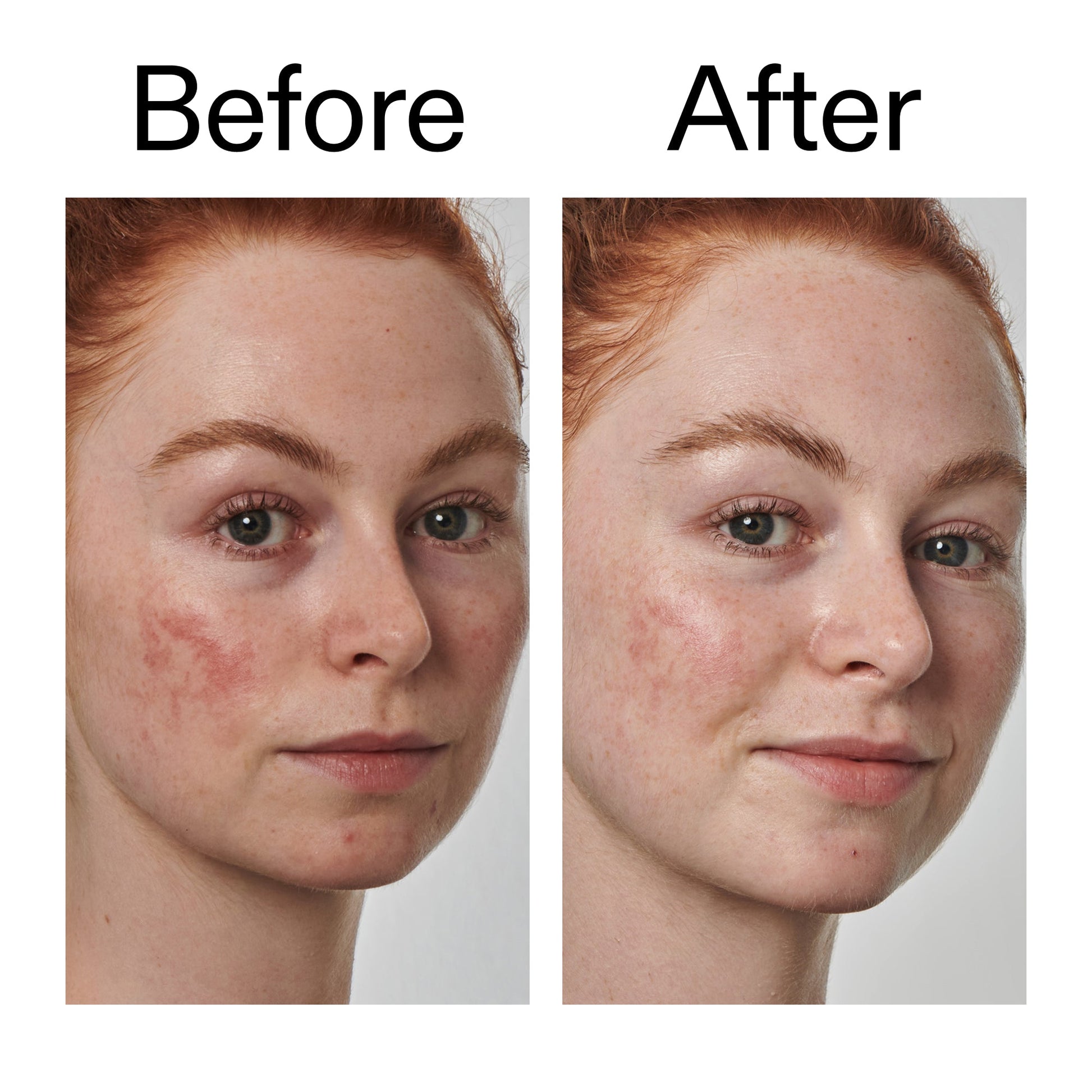 10-azelaic-acid-serum-for-redness-relief-f0 Redness_Relief_Serum_Before_After_2000x2000_3334dc9a-cce9-4e00-8aec-7ad89ca051f2.jpg