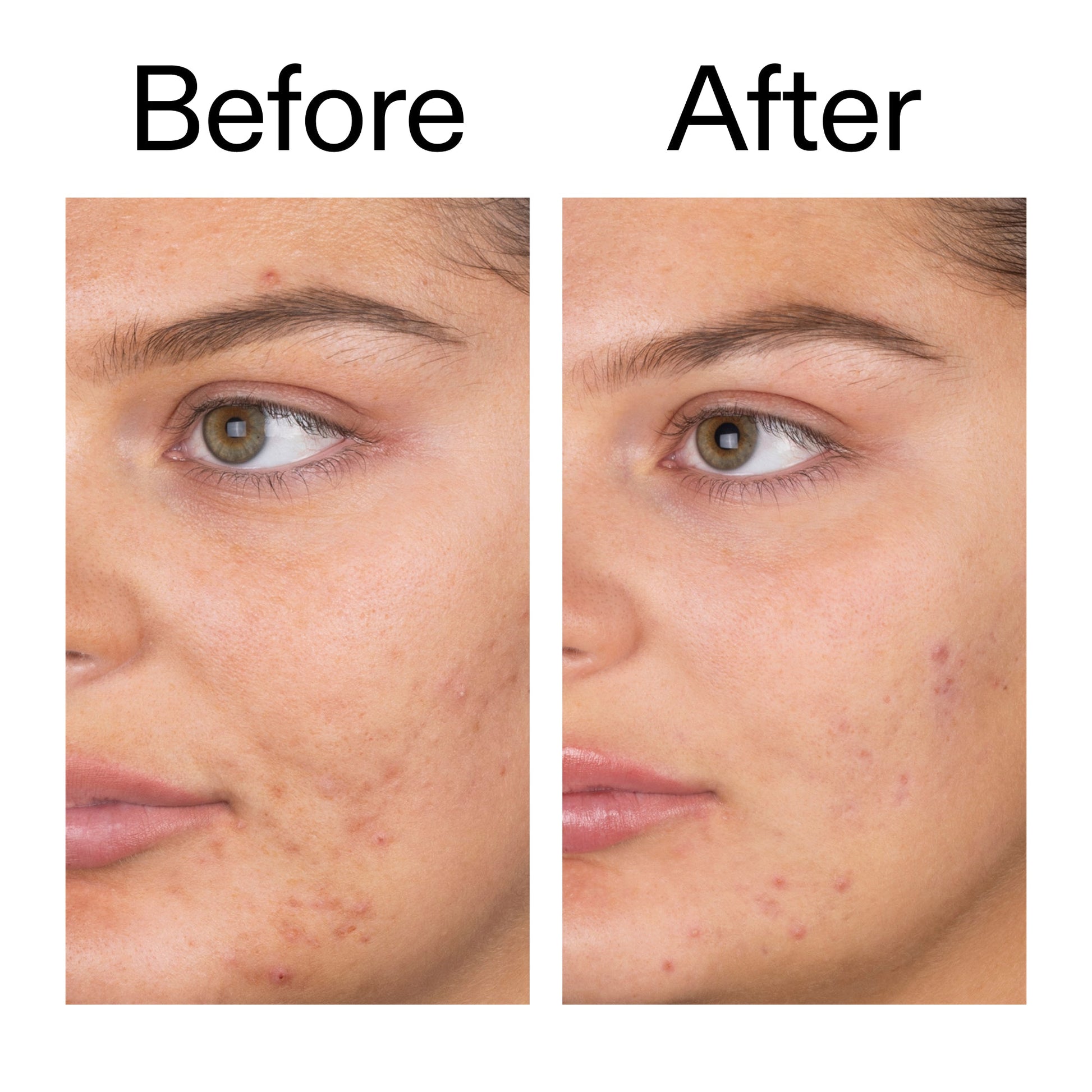 salicylic-acid-cleanser-150ml-b5 Salicylic_Acid_Cleanser_-_150ml_Before_After_2000x2000_e7230494-853f-4b07-82b1-27669104c995.jpg