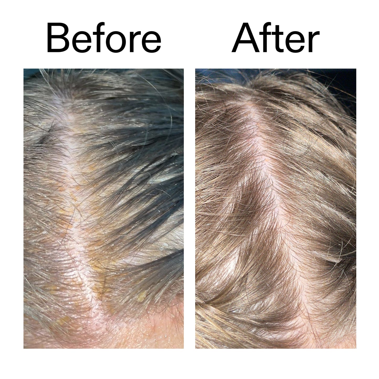 salicylic-acid-exfoliating-scalp-treatment-u9 Salicylic_Acid_Exfoliating_Scalp_Treatment_Before_After_2000x2000_e572a30f-057c-4a48-823b-1c09dc97f8d0.jpg