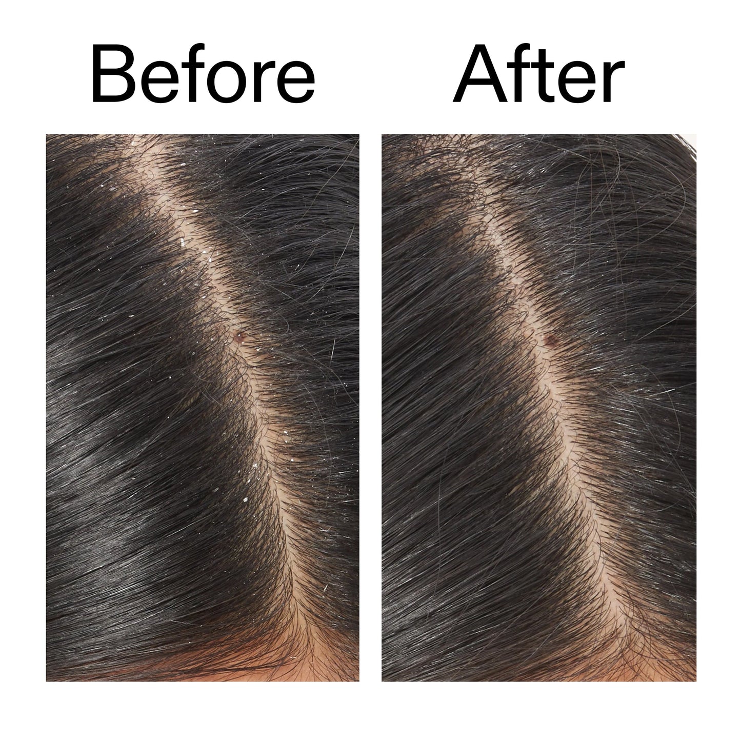 salicylic-acid-exfoliating-scalp-treatment-u9 Salicylic_Acid_Exfoliating_Scalp_Treatment_Before_After_V2_2000x2000_02bd61ad-42bf-490b-b3e3-7e04b2e8a673.jpg