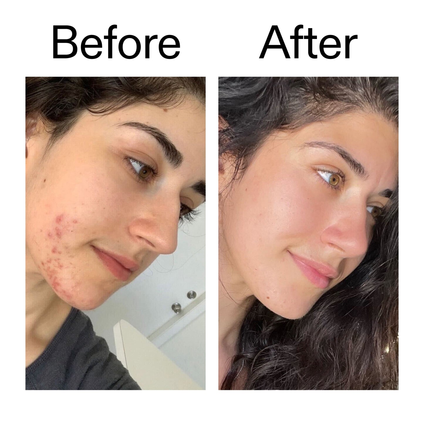 succinic-acid-acne-treatment-t8 Succinic_Acid_Treatment_Before_After_2000x2000_6a5f0054-2f58-4433-9314-0dc72c9bdd3b.jpg