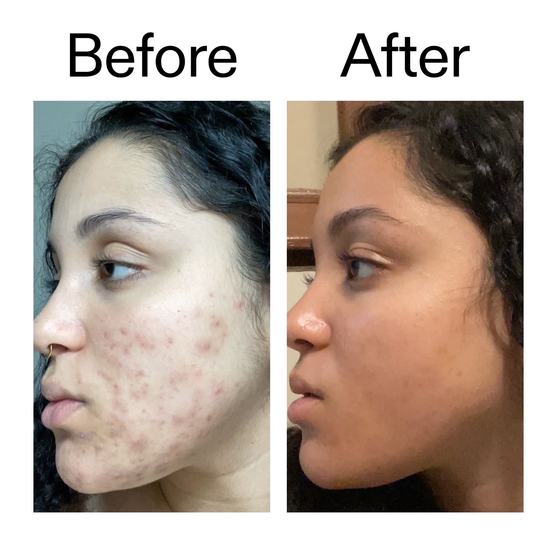 tranexamic-acid-serum-l3 Tranexamic_Acid_Serum_Before_After_2000x2000_98ebc8be-77b0-4843-8a22-90790ebe918b.jpg